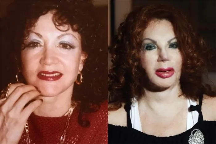 Жаклин Сталлоне до и после пластики