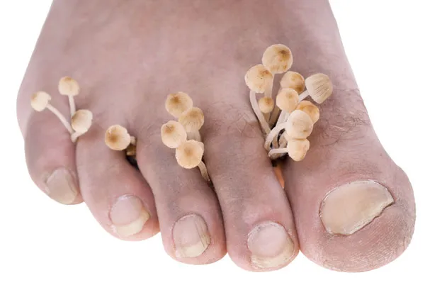 Грибковые заболевания ногтей: какова их природа?