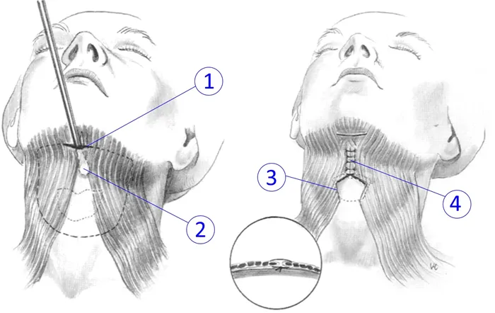 Метод подтяжки шеи - передняя платизмопластика