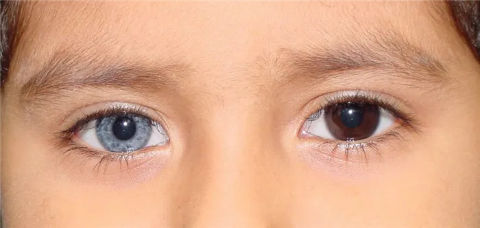 Что такое гетерохромия глаз