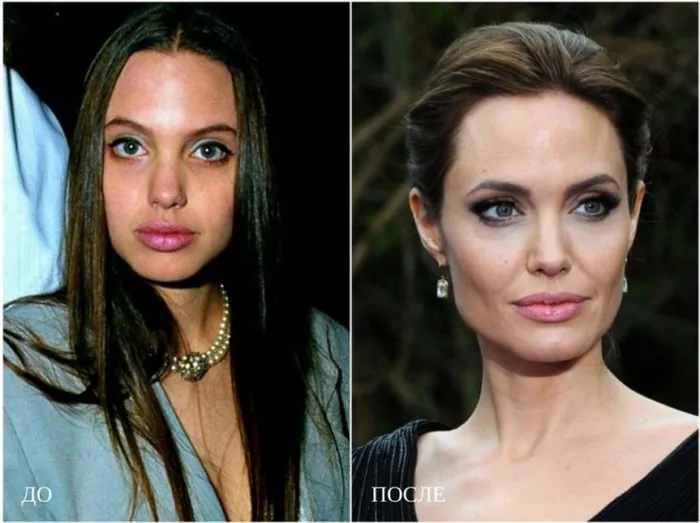 Пластическая хирургия Джоли