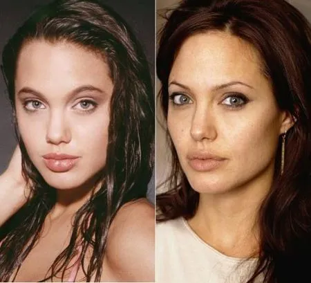 Пластика губ Анджелины Джоли.