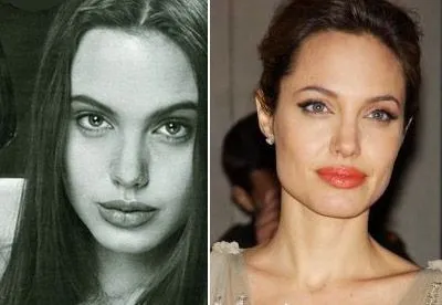 Пластика носа Анджелины Джоли.
