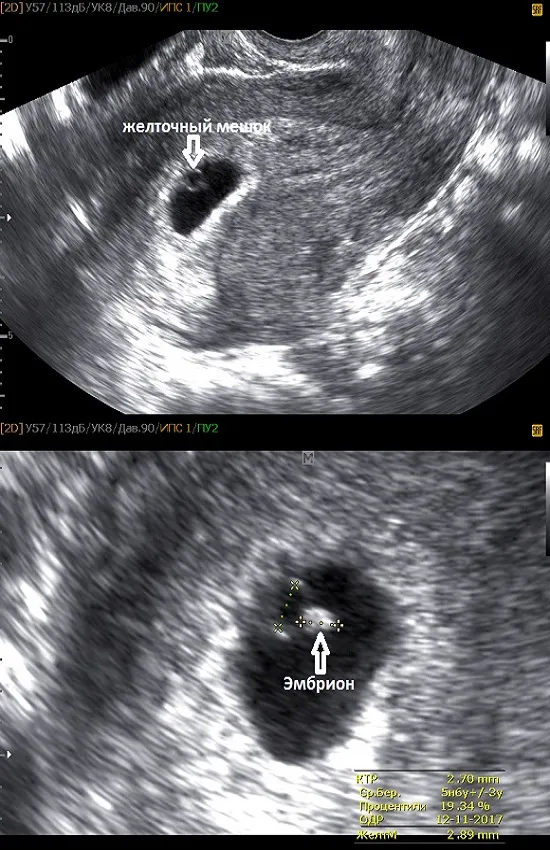 Фото УЗИ при беременности, фото плода при УЗИ во время беременности. Как выглядят беременные женщины 3