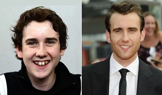 Машруис до и после выпрямления зубов