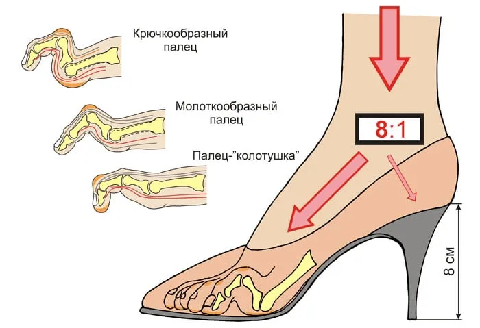 Реальный вред обуви на высоких каблуках для здоровья: правда или вымысел?