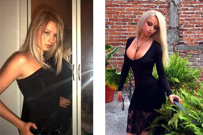 Валерия Луканова до и после операции