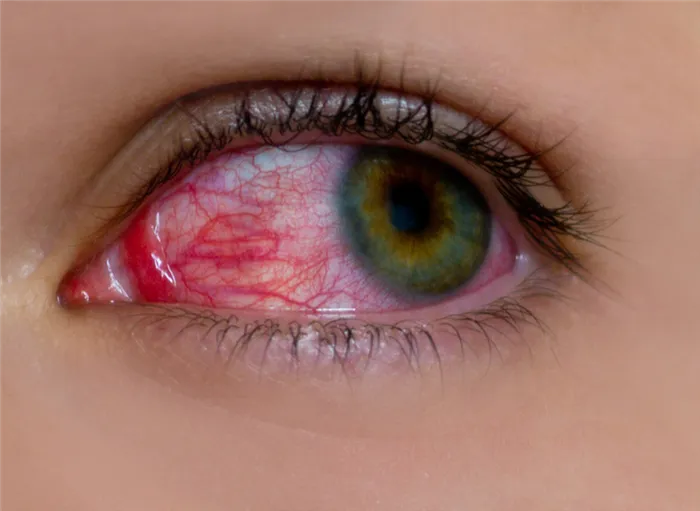 Химический ожог роговицы глаза: признаки и лечение. Крем попал в глаза что делать 2