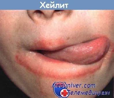 Cheilitis - воспаление губ после облизывания.