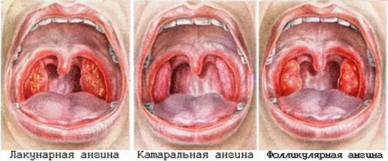 Симптомы и лечение ангины у взрослых. Как выглядит ангина певица болезнь 2