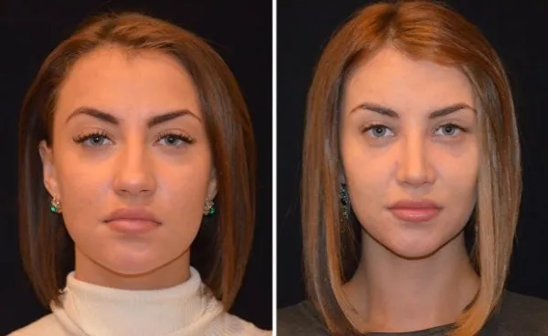Виктория Берникова до и после пластической операции. Параметры формы.