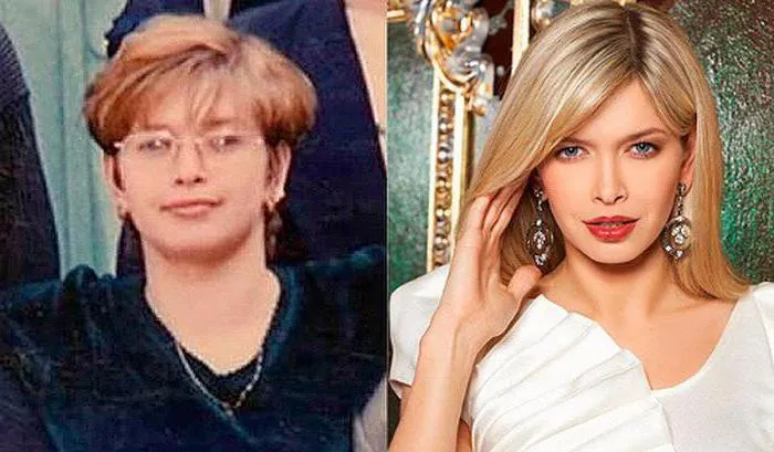 Вера Брежнева до и после пластической операции.