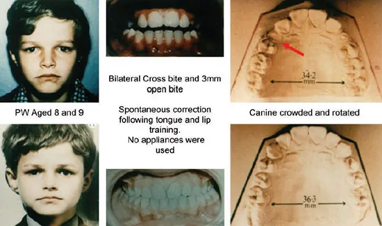 Взаимосвязь между положением языка и шириной верхней челюсти