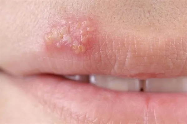 простуда на губах народное лечение 65