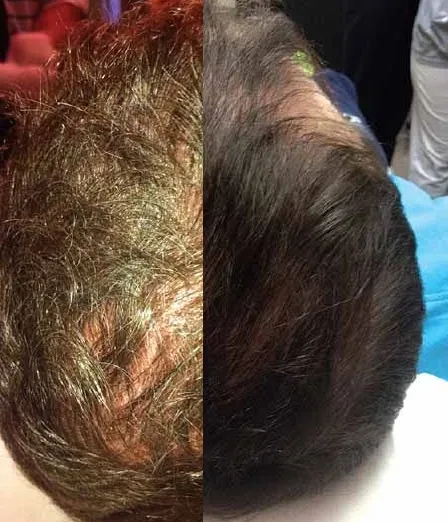 Выпадение волос: финастерид, лазер или миноксидил — что действительно поможет мужчинам и женщинам восстановить потерянные волосы на голове. Какие таблетки для роста волос? 5