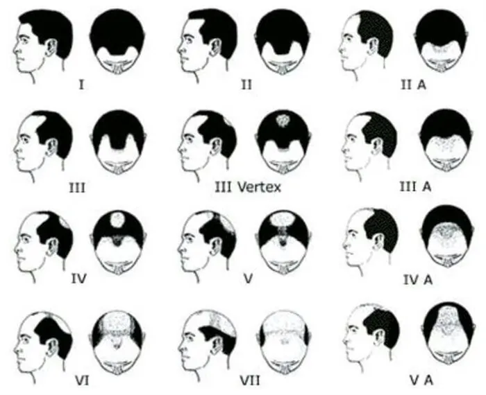 Выпадение волос: финастерид, лазер или миноксидил — что действительно поможет мужчинам и женщинам восстановить потерянные волосы на голове. Какие таблетки для роста волос? 3