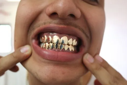 Золотые зубы у реперов как называются. Золотые зубы у реперов как называются? 6