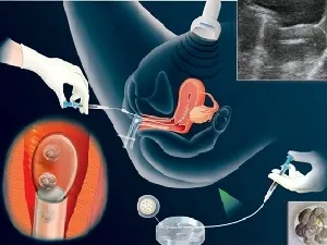 Имплантация эмбрионов после пересадки при ЭКО и возможные ощущения. 11 дпп пятидневок нет никаких ощущений? 2