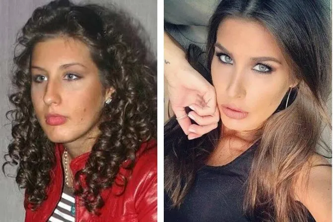 Кэти Топурия до и после пластики носа