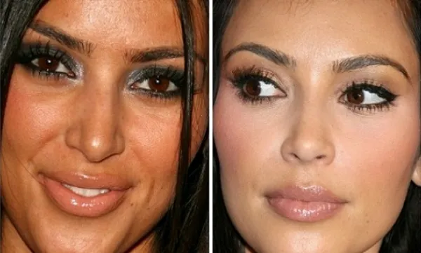 Ким Кардашьян до и после пластики носа