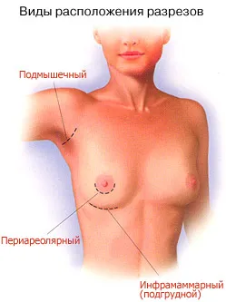 Виды расположения резрезов при операции по увеличению груди