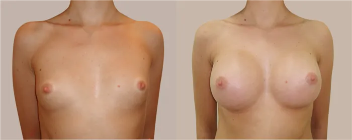 Увеличение груди. Видео как увеличивают грудь? 8