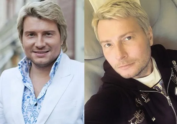 Николай Басков до и после пластики
