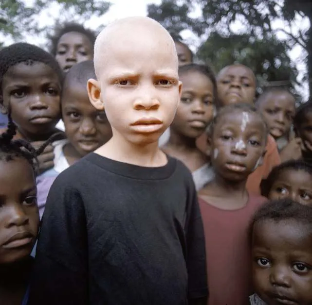 albinizm-21-.jpg