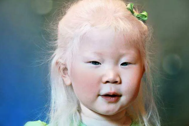 albinizm-10-.jpg