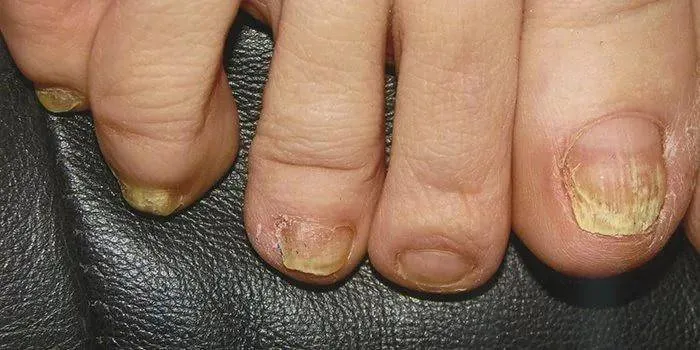 Грибок ногтей пальцев ног