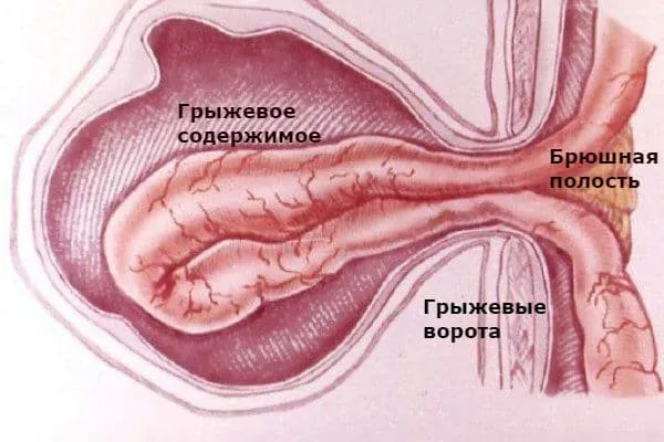 Механизм формирования грыжи живота