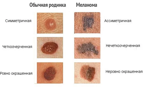 Статистика заболеваемости меланомой кожи. Кто умер от меланомы? 3
