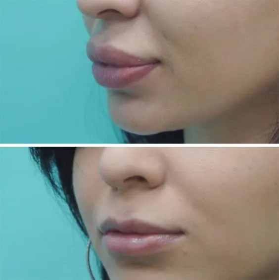 Коррекция опущенных уголков губ. Уголки губ опущены вниз что делать? 2