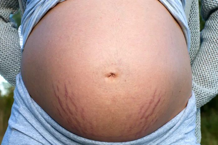 Растяжки во время беременности. Как сохранить красоту