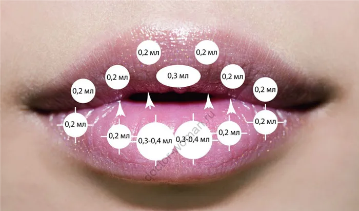 Правильное использование гиалуроновой кислоты для губ