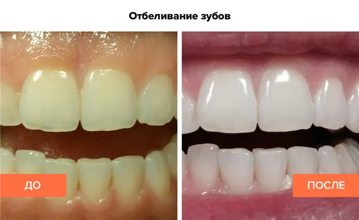 Фото пациента до и после отбеливания зубов