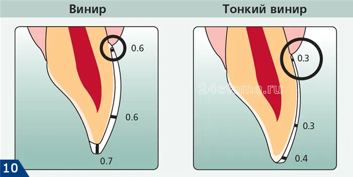 Схема сошлифовывания эмалевого слоя на передней поверхности зубов - для виниров стандартной толщины и тонких виниров
