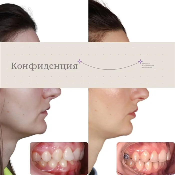 Как прикус определяет черты лица: советы стоматологов. Как прикус влияет на лицо. 3