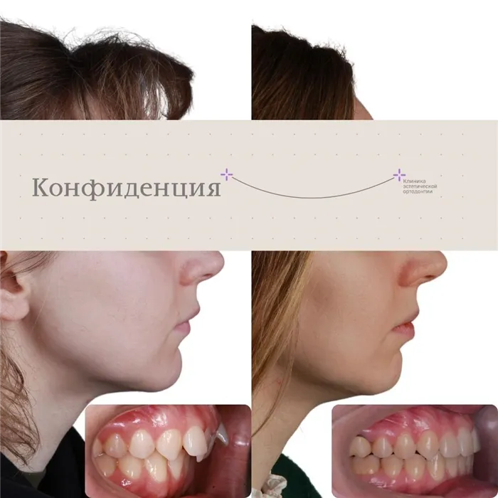 Как прикус определяет черты лица: советы стоматологов. Как прикус влияет на лицо. 4