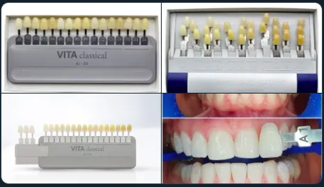 Натуральные зубы никогда не будут белоснежными. Стоматолог честно рассказал о современных методах отбеливания и подводных камнях процедуры. Как сделать белые зубы. 3