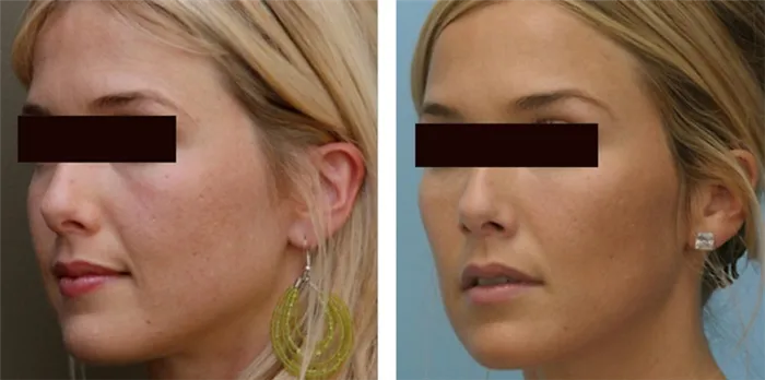 Курносые носы: фото до и после операции