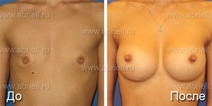 Импланты груди