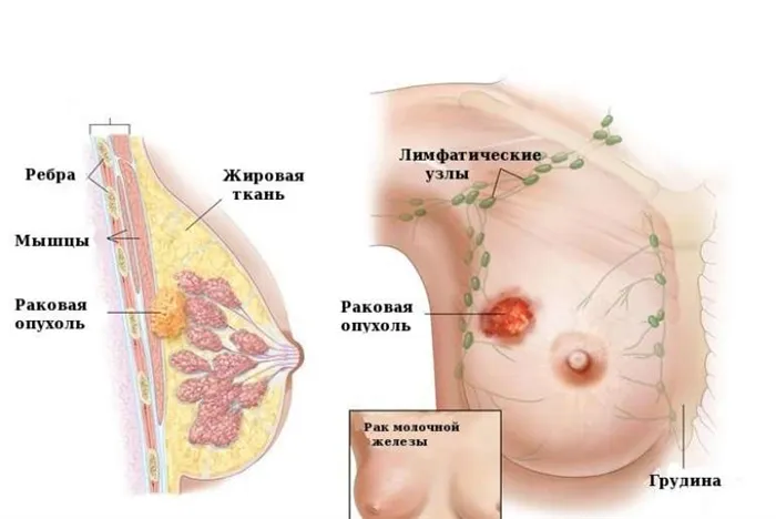 Как определить рак груди. Как болит рак груди. 2