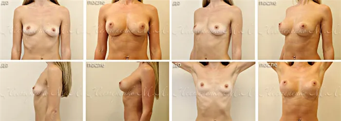Виды грудных имплантов. Какие импланты лучше ставить грудные. 9