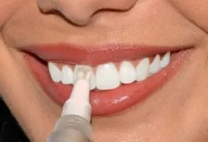 Отбеливание зубов в домашних условиях. Как быстро отбелить зубы. 4