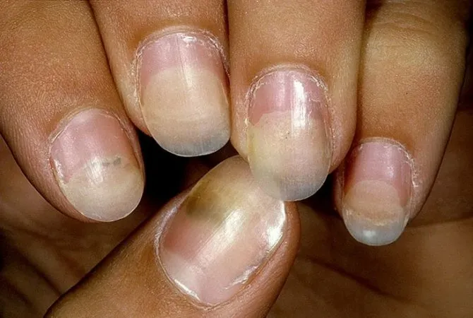 Потемнения на ногтях после наращивания и гель-лака – это не грязь, а инфекция