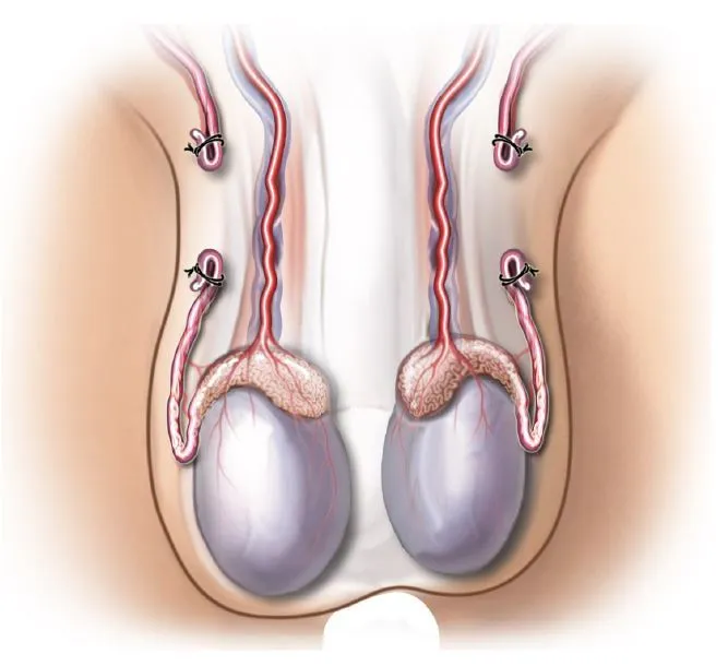 Операция вазэктомия: мужская стерилизация. Вазэктомия плюсы и минусы 14