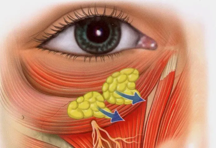 Устранение малярных мешков. Как убрать мешки под глазами хирургическим путем? 34