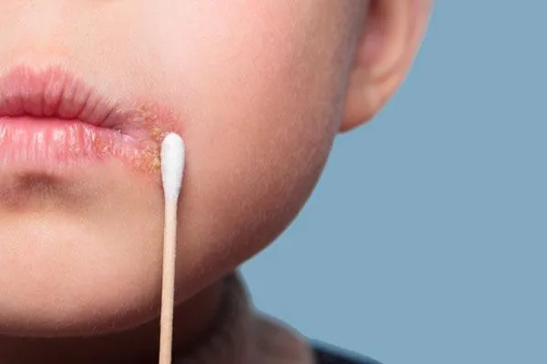 Простуда на губах: как и чем быстро вылечить. Как вылечить простуду на губе? 2