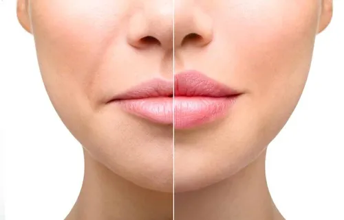 Отек после увеличения губ гиалуроновой кислотой. Почему после увеличения губ они стали больше. 3